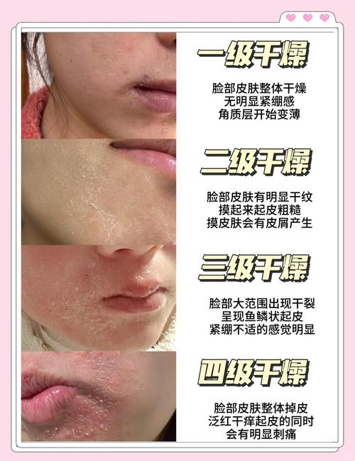 脸起皮用什么护肤品