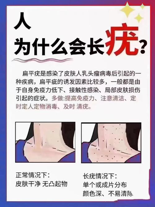 长痦子是什么原因