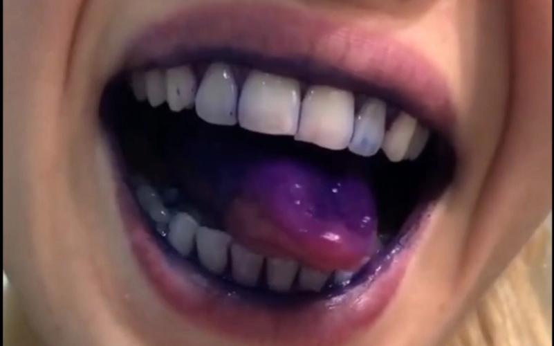 牙齿上黑色的是什么