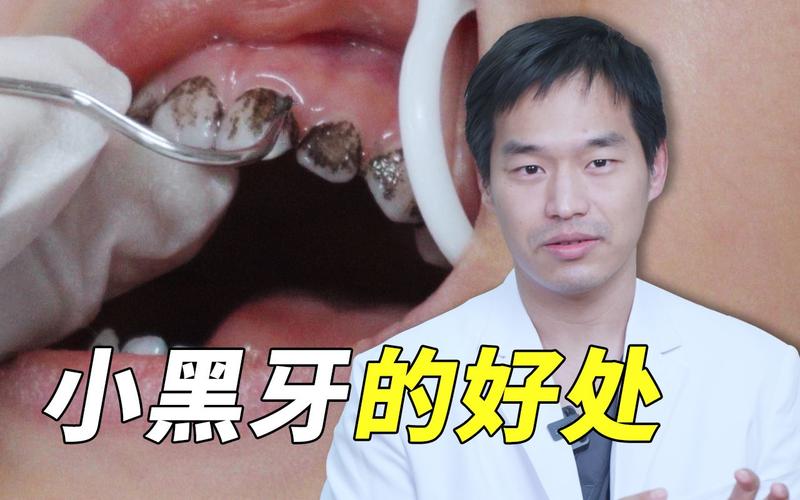 牙齿上黑色的是什么