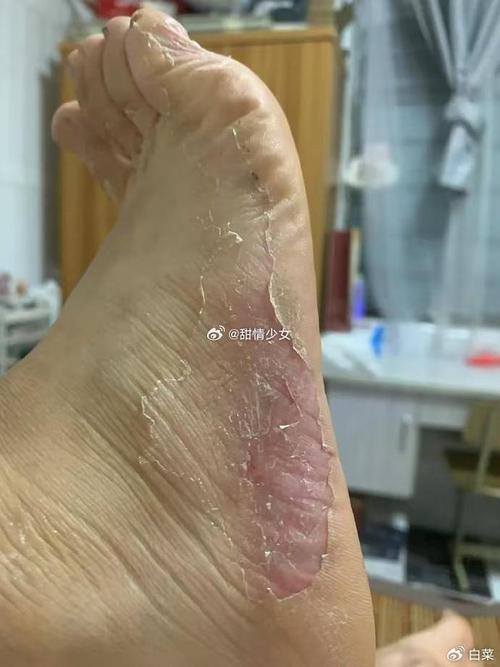 手脚脱皮是什么病