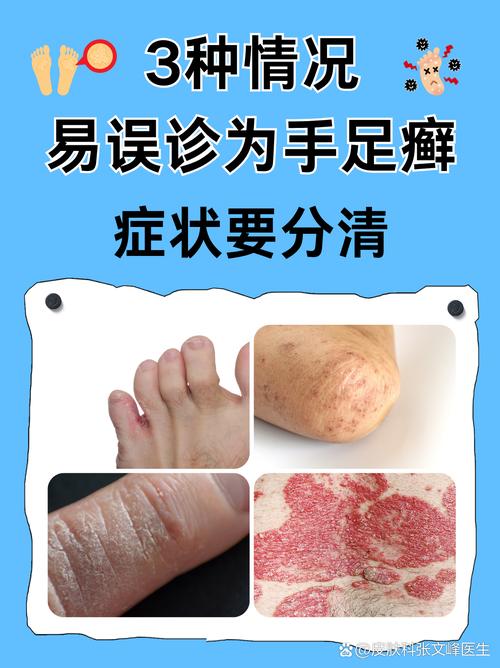 手脚脱皮是什么病