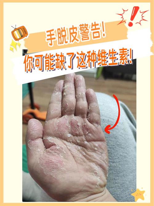 手脚脱皮是什么病