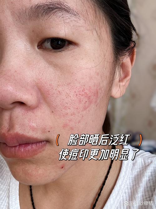 whoo洗面奶 过敏