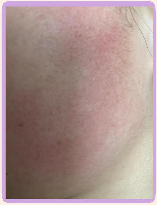 whoo洗面奶 过敏