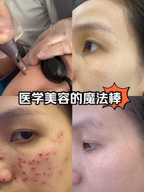 什么是激光祛斑