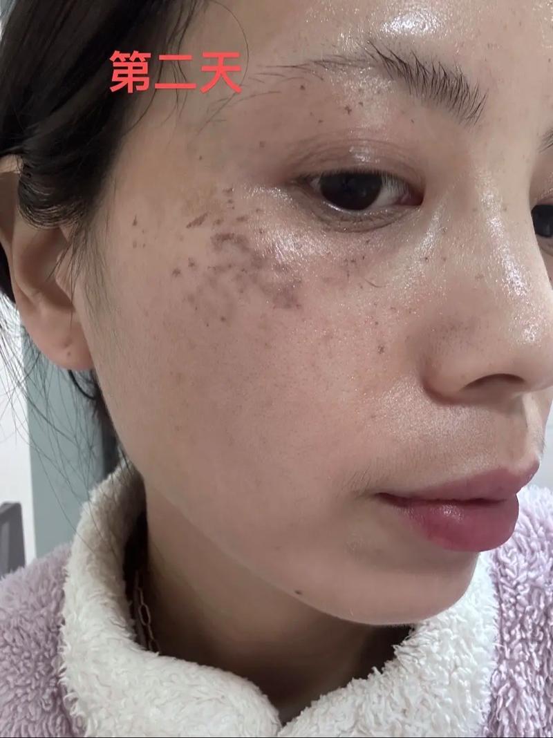 什么是激光祛斑