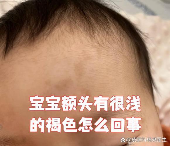 小孩为什么会长斑