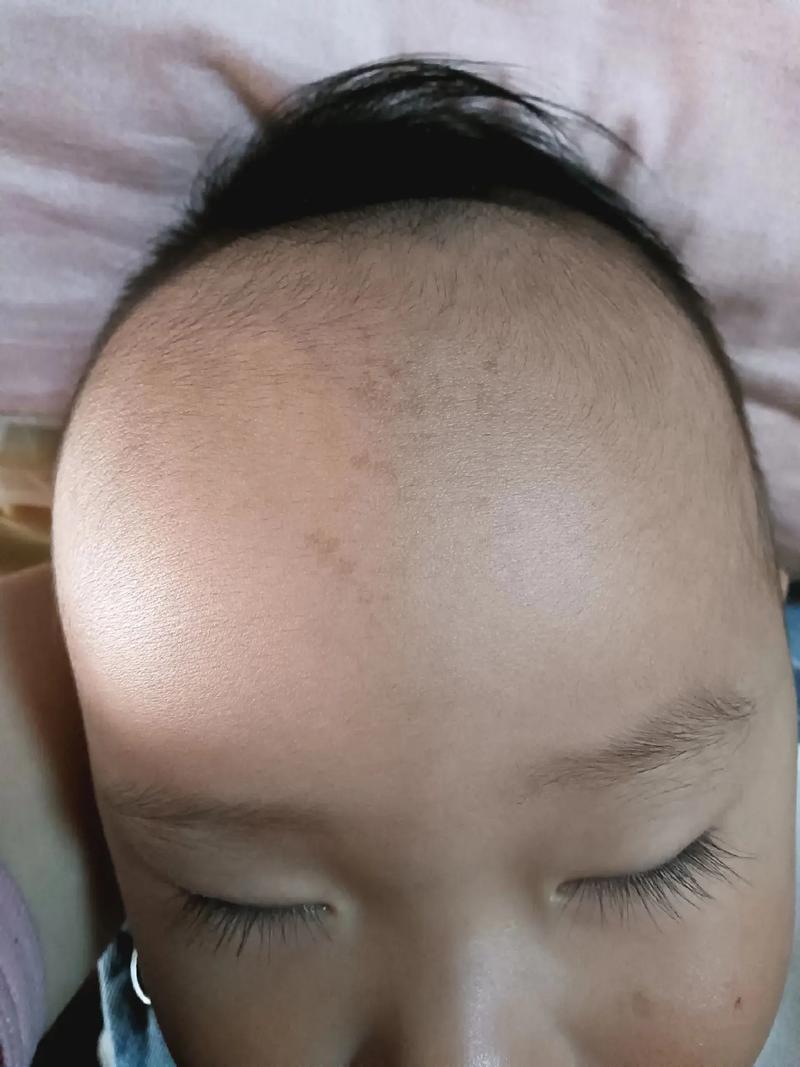 小孩为什么会长斑