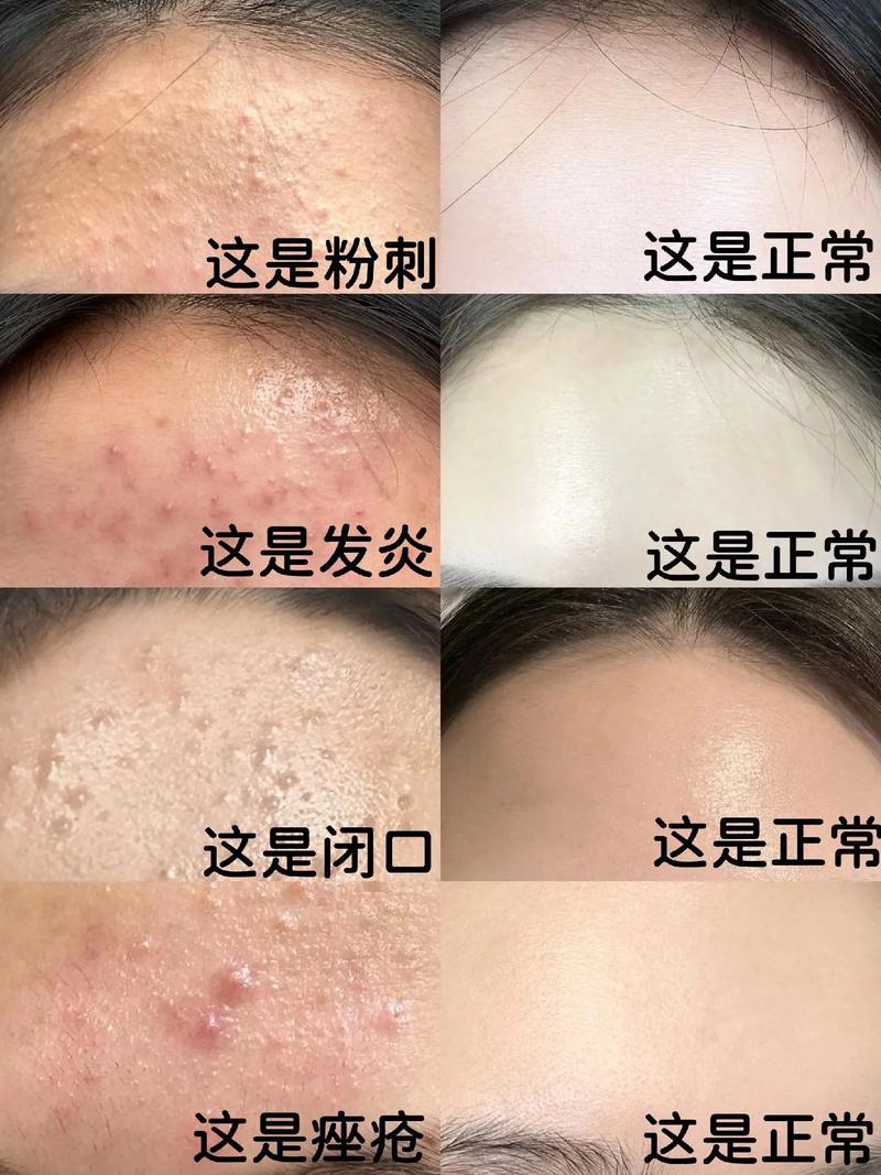 脸上的闭口是什么