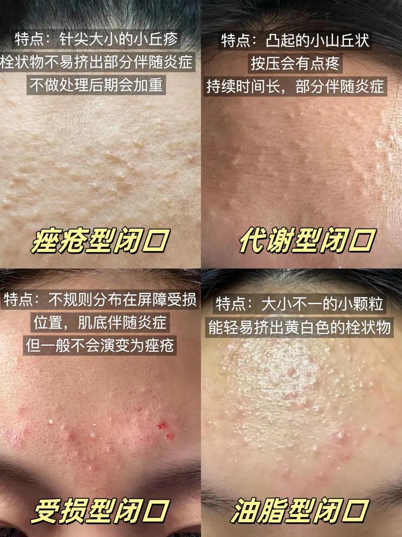 脸上的闭口是什么