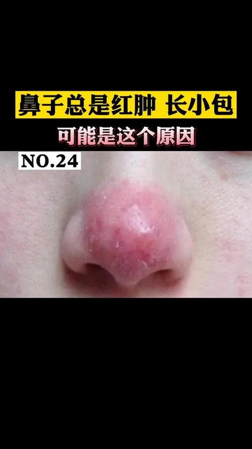 鼻尖红是什么原因