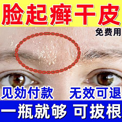 脸上有干皮用什么护肤品