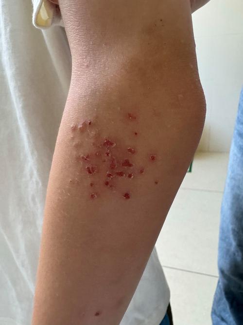 过敏性皮炎是什么