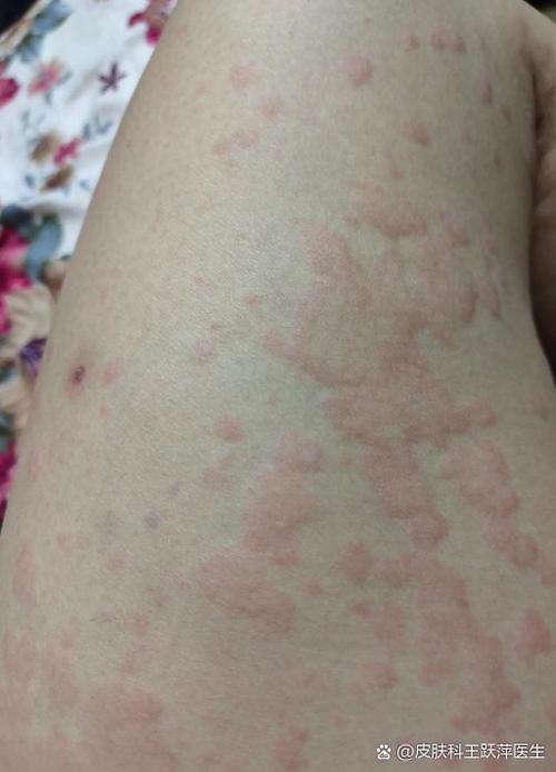 过敏性皮炎是什么