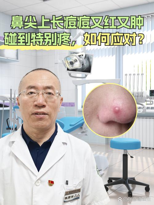 鼻尖长痘什么原因