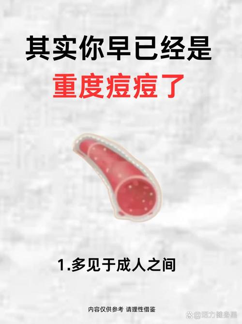 鼻尖长痘什么原因