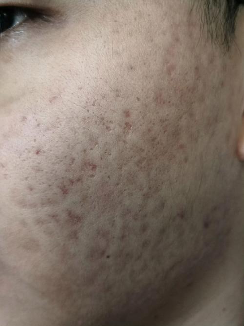 痘印长什么样子