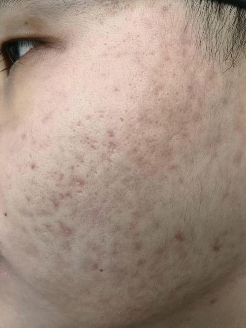 痘印长什么样子