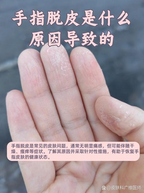 为什么手一直脱皮