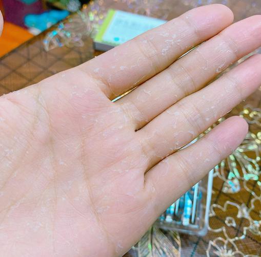 为什么手一直脱皮