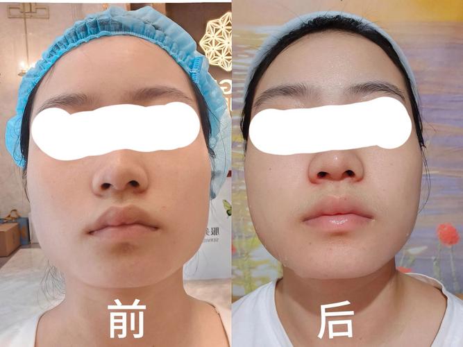 打什么针可以瘦脸