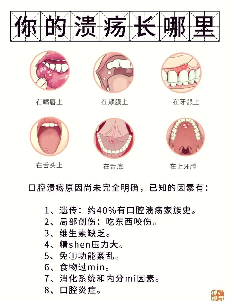 嘴溃疡是什么原因