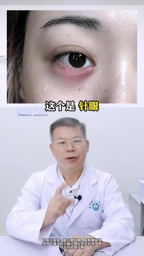 为什么眼睛长针眼