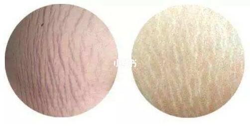 橘皮组织是什么