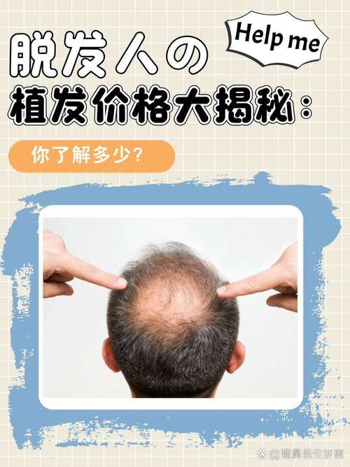 什么是头发种植