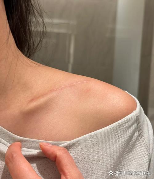 锁骨为什么不明显