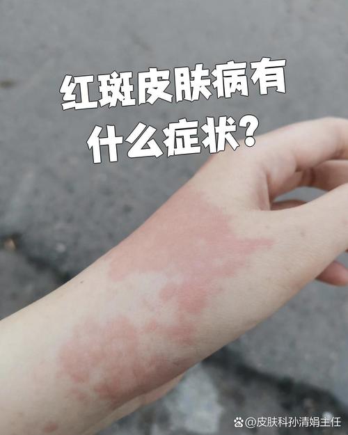 什么叫红斑狼疮