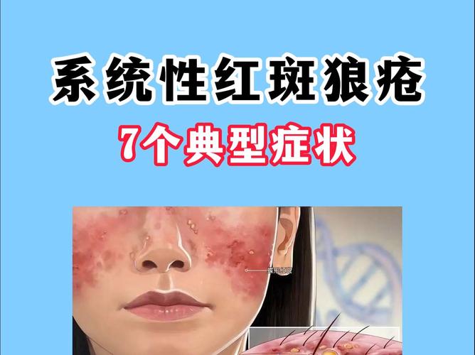 什么叫红斑狼疮