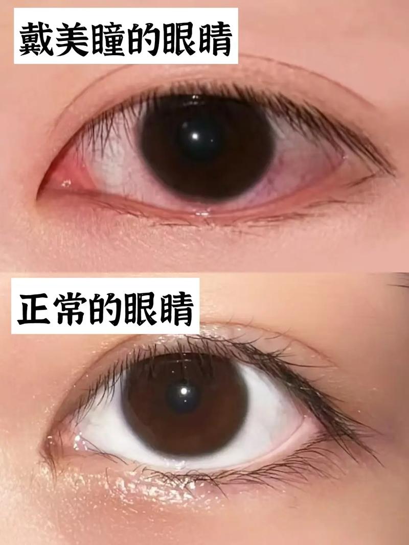 美瞳有什么坏处