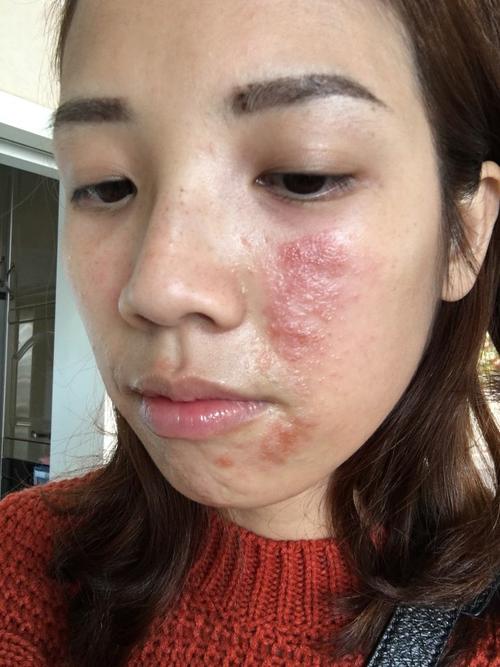 脸过敏不能吃什么