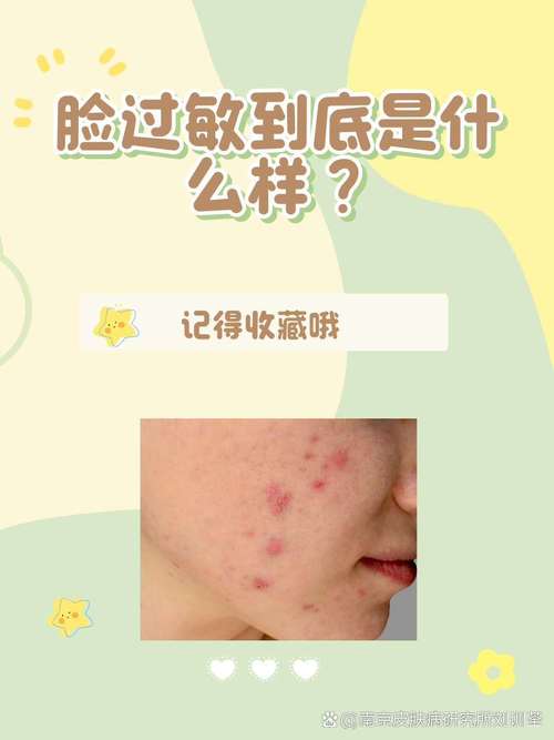 脸过敏不能吃什么