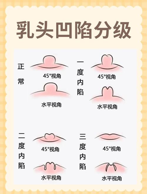 什么是乳头内陷