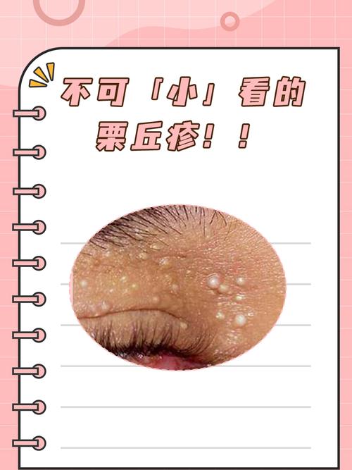 什么叫丘疹