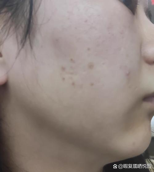 氨基酸洗面奶祛痘好吗