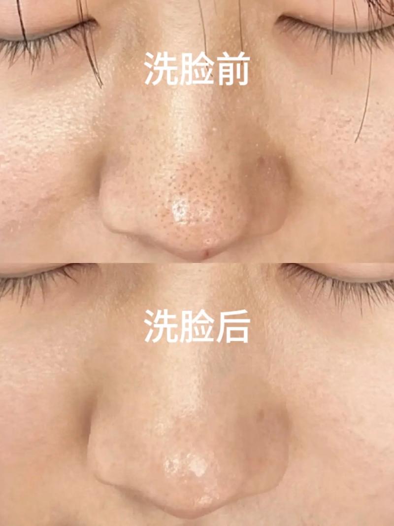 洗面奶把黑头洗出来了