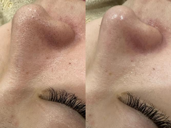 洗面奶把黑头洗出来了