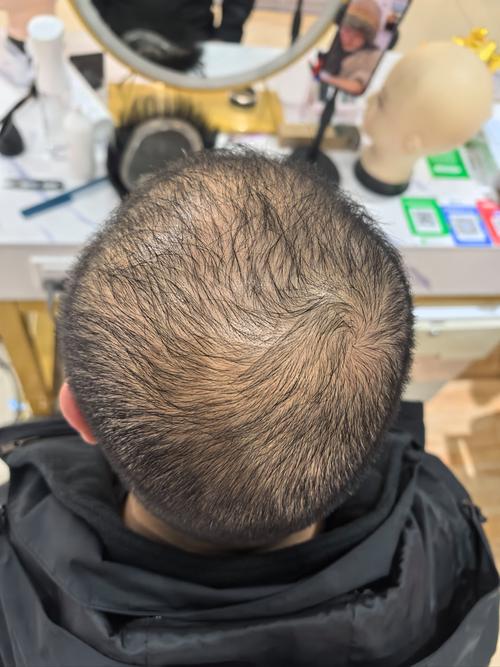 男人为什么脱发