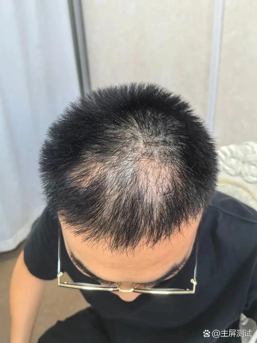 男人为什么脱发