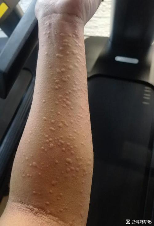 麻疹是什么样子的