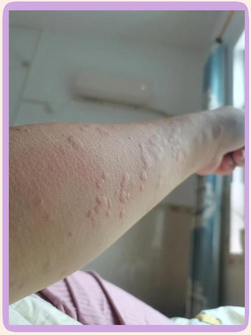 麻疹是什么样子的