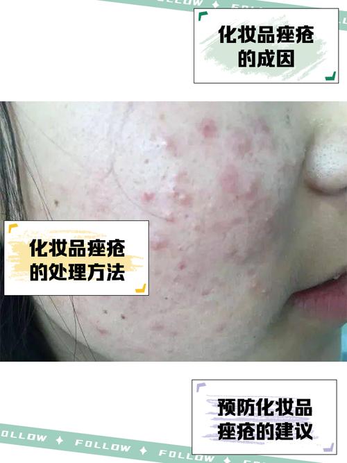 用护肤品起痘是排毒吗