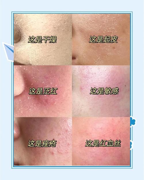 脸擦护肤品就红怎么办