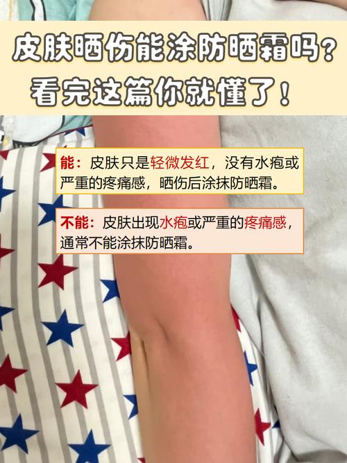 晒伤后可以用护肤品吗