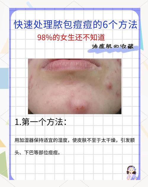 护肤品用了爆痘怎么办