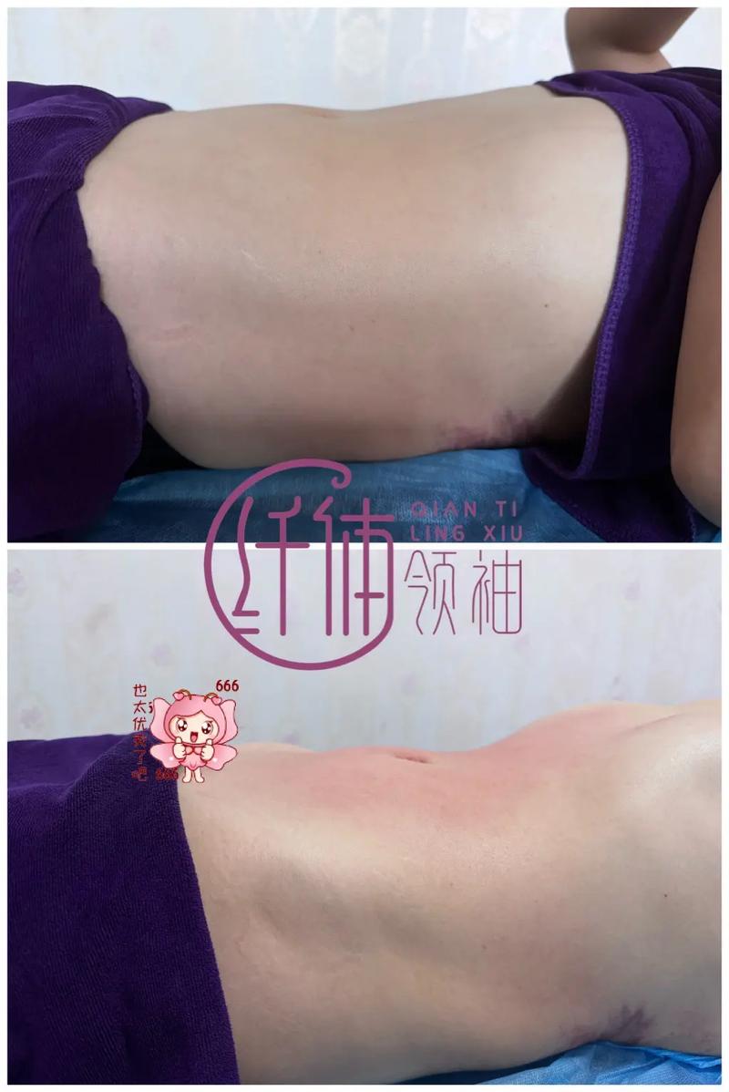 体雕减肥是什么意思